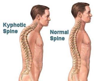 kyphosis.jpg - large